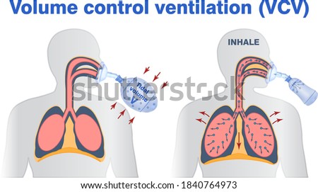 Illustration of vollume control or support artifitial ventilation. Tidal volume, mask ventilation, breathing resuscitator bag ventilation.