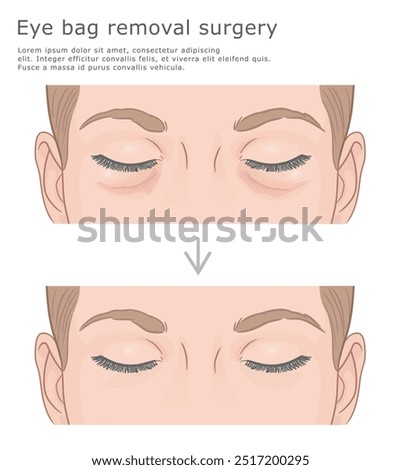 Eye bag removal surgery before and after vector illustration. Facelift medical illustration.