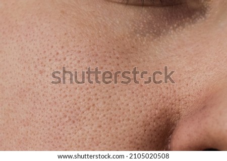 The skin of a woman's cheek with clogged pores before cleaning Foto stock © 