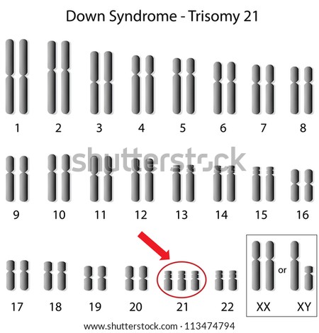 Down Syndrome Karyotype Stock Photo 113474794 : Shutterstock