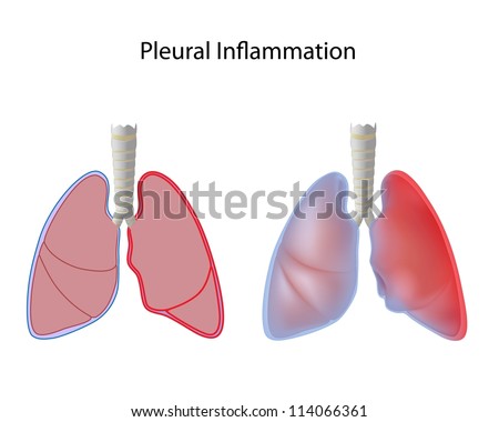 Inflammation Of Pleura, Pleurisy Stock Photo 114066361 : Shutterstock