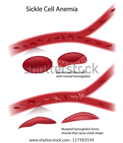 Sickle Cell Disease Stock Vector Illustration 117983590 : Shutterstock