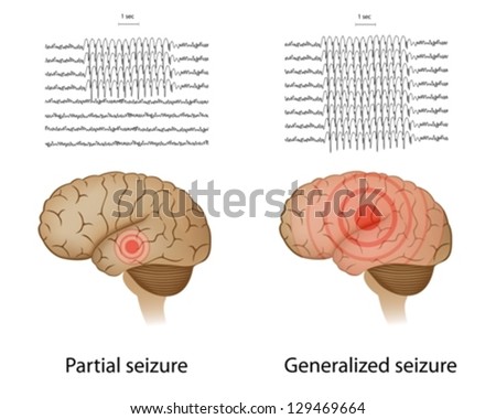 EEG In Partial And Generalized Epilepsy