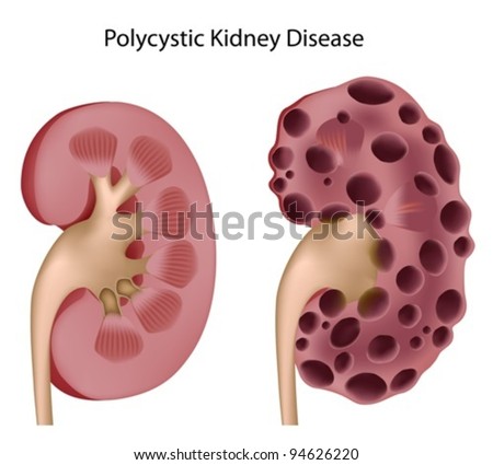 Polycystic Kidney Disease Stock Vector Illustration 94626220 : Shutterstock