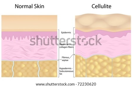 Cellulite versus smooth skin