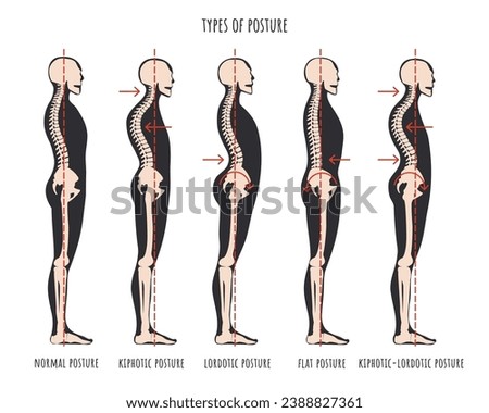 Type of posture, postural syndromes infographic. Skeletal samples of back problem kyphosis, lordosis and flat back. Normal posture medical educational poster. Vector illustration.