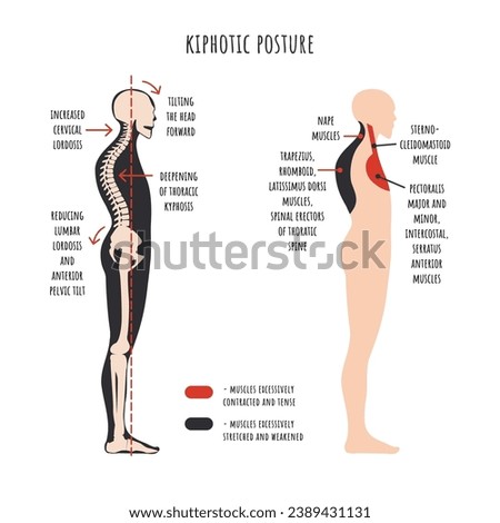Posture disorders infographics. Kyphotic posture. The side view shows deformation of rounded shoulders, spine curvature, pelvis rotation, stretched and weakened, shortened and tens muscles. Vector.