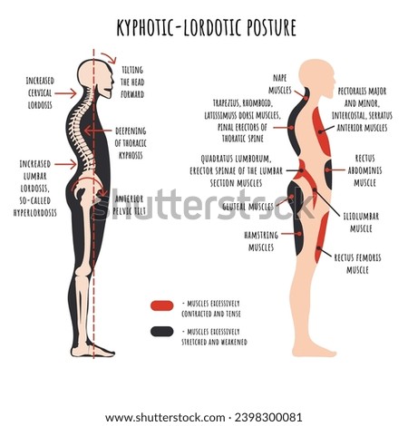 Posture disorders infographic. Kyphotic lordotic posture. The side view shows deformation of rounded shoulders and hyperlordosis, pelvis rotation, stretched and weakened, shortened and tens muscles.