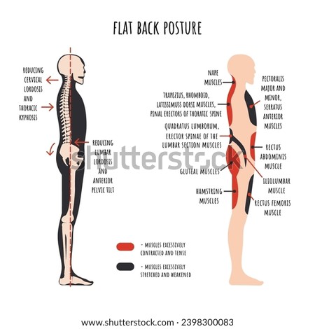 Posture disorders infographics. Flat back posture. The side view shows characteristic decrease natural curves of spine, pelvis rotation, stretched and weakened, shortened and tens muscles. Vector.