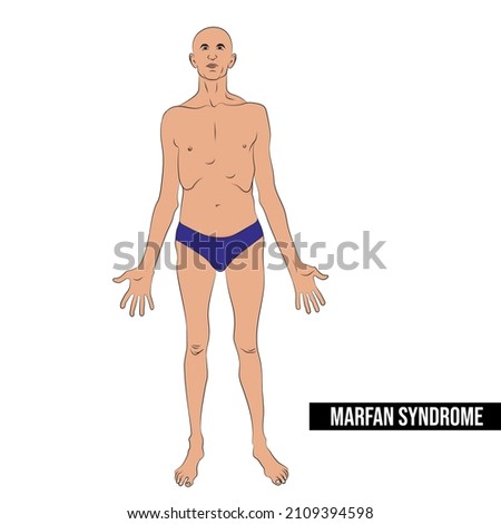People with Marfan syndrome are tall and thin, and have long arms, legs, and fingers. Imagine de stoc © 
