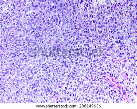 Fibrosarcoma of a human, photomicrograph panorama as seen under the microscope, 200x zoom.