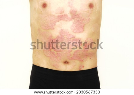 psoriasis skin disease dermatitis scab body inflamed skin Foto stock © 
