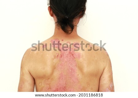 inflamed skin psoriasis skin disease dermatitis scab skin Foto stock © 
