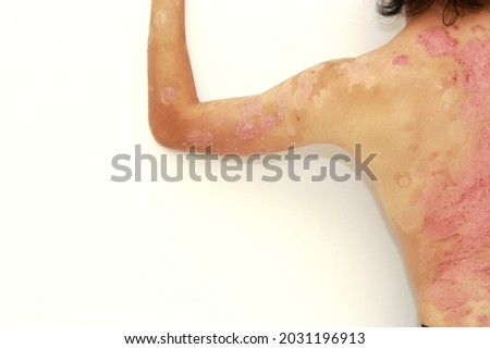 psoriasis skin disease dermatitis scab skin  Foto stock © 