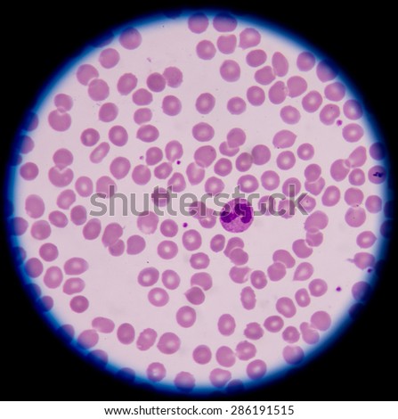 A neutrophil is a type of mature (developed) white blood cell
that is present in the blood. White blood cells help protect
the body against diseases and fight infections.