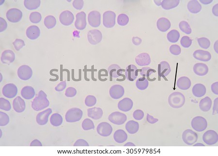 Target cells are found in peripheral blood films in a number of conditions. The commonest are liver disease and the presence of variant haemoglobins or thalassaemia.