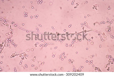budding yeast cells with pseudohyphae in urine sample fine with microscope.