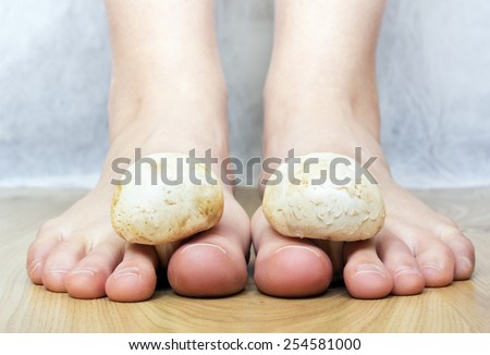 Close view of a white mushrooms between the toes feet imitating toes fungus
