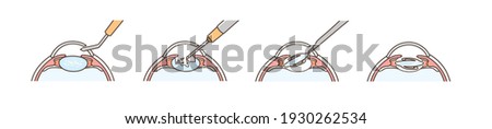 Illustrations for explaining cataract surgery. Stock foto © 