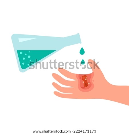 Chemical acid burn on hand skin in flat design on white background.