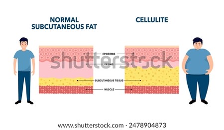 Cellulite concept, excess fat in human body. Overweight and increase subcutaneous fat diagram. Obese people, diet program. Skin layers structure epidermis, dermis and hypodermis vector illustration.