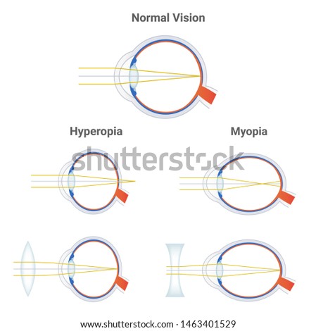 myopia hyperopia kép)