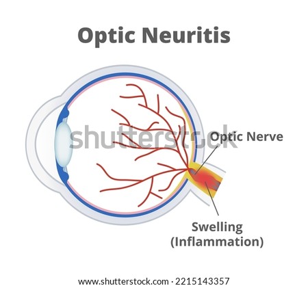 Vector medical illustration of optic neuritis isolated on white background. Nerve fibers are inflamed, and the optic nerve is swollen. Temporary vision loss and visual field loss. Eye inflammation.