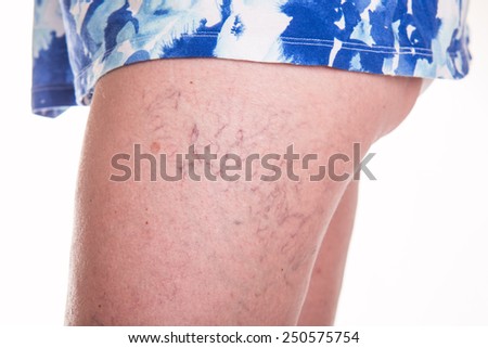 Human spaider veins on the legs of woman - studio shoot