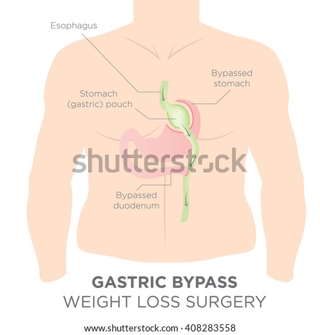 Gastric Bypass for Weight Loss - You Are Actually Re-routing Your Stomach in Order to Feel Full and Eat Less