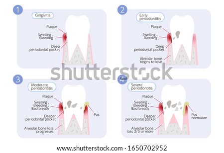 Periodontal disease progression illustration, 4 stages
