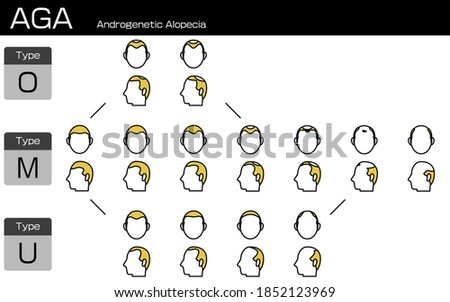 Illustration of each type of AGA androgenetic alopecia and progress stage
