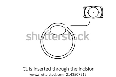 Illustration of ICL (intraocular contact lens) surgery and ICL insertion