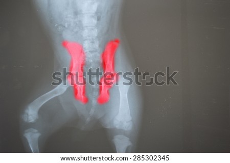 x ray for pelvis bone