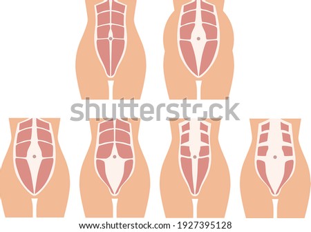 diastasis in a woman after pregnancy and childbirth. increased distance between the rectus abdominis muscles in a woman after childbirth. muscle corset of a woman after childbirth.