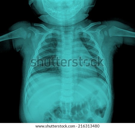 Chest x-ray film of children ( chest postero-anterior )
