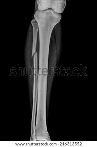 X-rays of leg fracture patients ( Leg Antero-posterior )