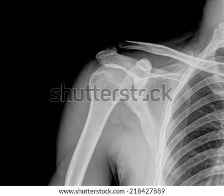 x-rays image of the painful or injury shoulder joint ,shoulder dislocation