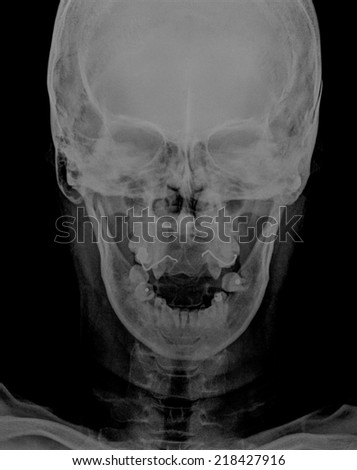 X-ray picture of the skull,open mouth