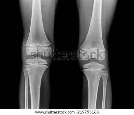 2 Knee x-ray
