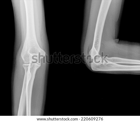 Right elbow radiography. Open and closed position