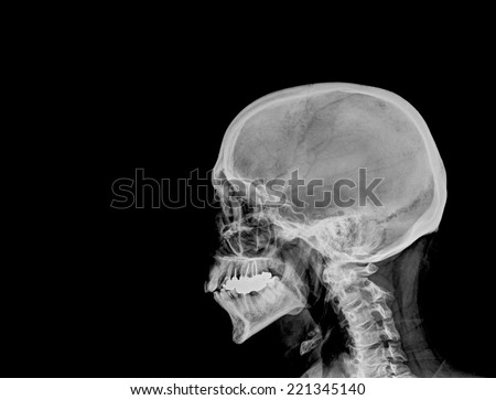 Film x-ray Skull lateral : show normal human\'s skull and cervical spine and blank area at left side