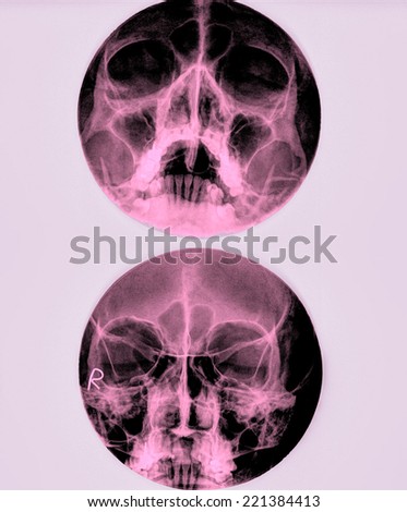 X-Ray film of face - frontal, looking up