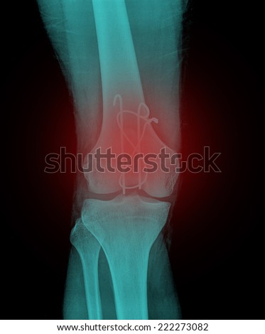 AP x-ray of injured knee front side