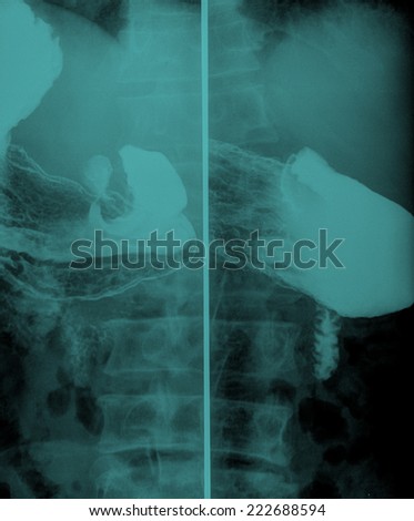 X-ray with opaque contrast medium that shows intestine: spine and hip in background