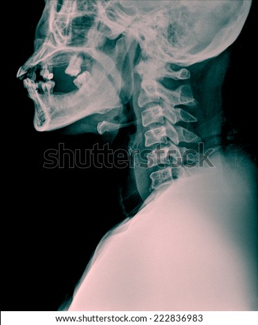 X-rays of the neck of old woman patient, showing bones or cervical vertebrae from the side.