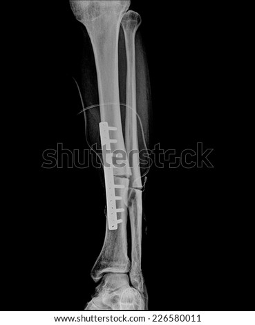 X-ray of the broken leg