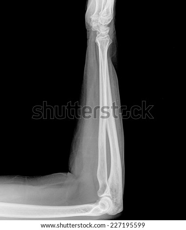 X-ray of both human arms.