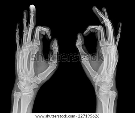 film x-ray both hand AP : show normal human's hands on black background (isolated)