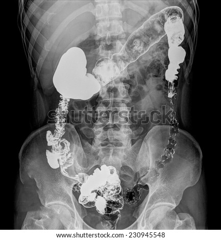 Colon / Large Instestine - Male anatomy of human organs - x-ray view
