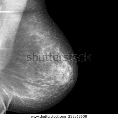 mammography breast scan X-ray image